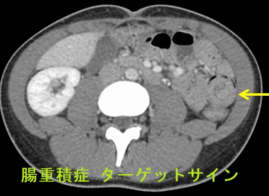 腸重積症 造影CT検査 ターゲットサイン 腸重積症 造影CT検査 ターゲットサイン
