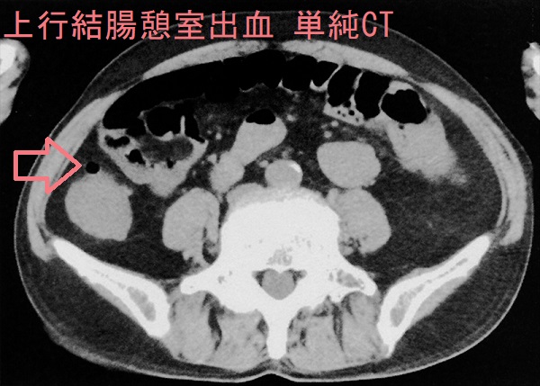上行結腸憩室出血 単純CT 上行結腸憩室出血 単純CT