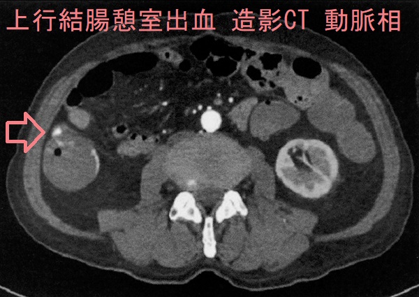 上行結腸憩室出血 造影CT 動脈相 上行結腸憩室出血 造影CT 動脈相