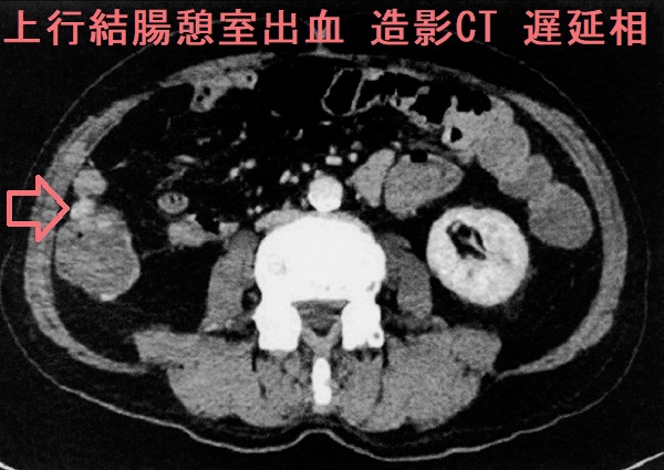 上行結腸憩室出血 造影CT 遅延相 上行結腸憩室出血 造影CT 遅延相