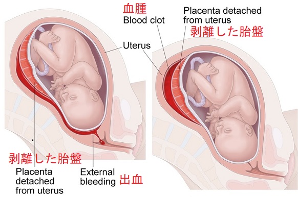 胎盤早期剥離 胎盤早期剥離
