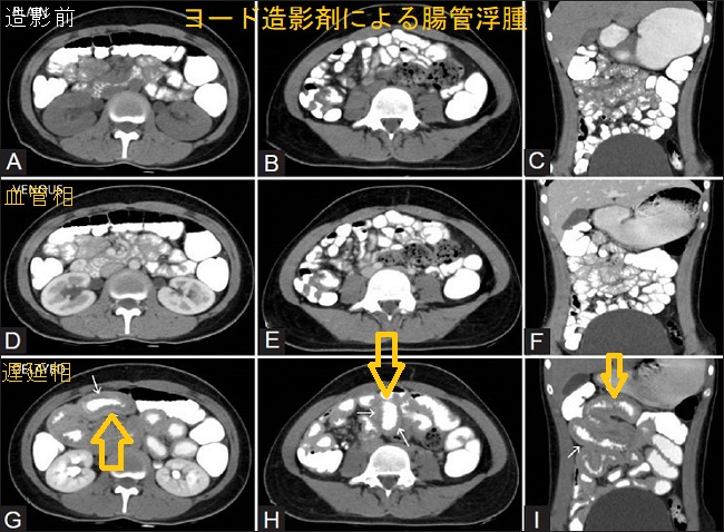 ヨード造影剤による腸管浮腫 ヨード造影剤による腸管浮腫