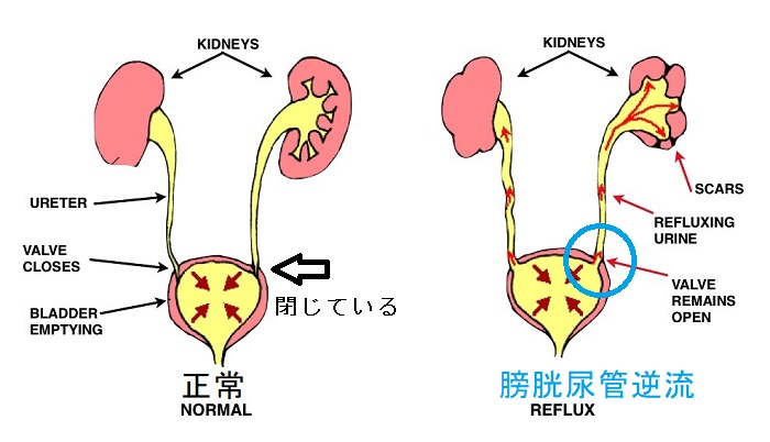 膀胱尿管逆流 膀胱尿管逆流