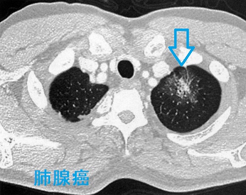 肺腺癌 CT画像 肺腺癌 CT画像