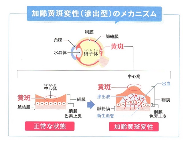 加齢黄斑変性症 3 加齢黄斑変性症 3