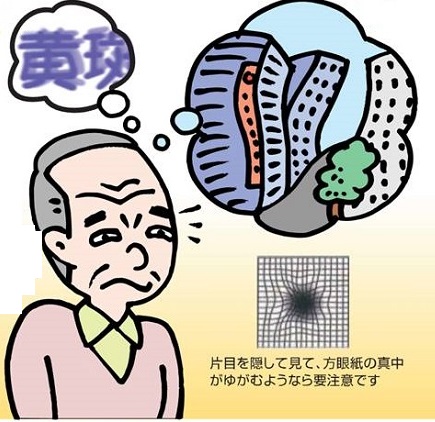 加齢黄斑変性 歪んで見える 加齢黄斑変性 歪んで見える
