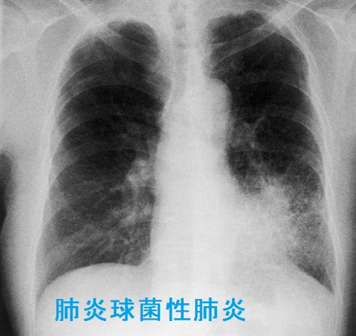 肺炎球菌性肺炎 肺炎球菌性肺炎