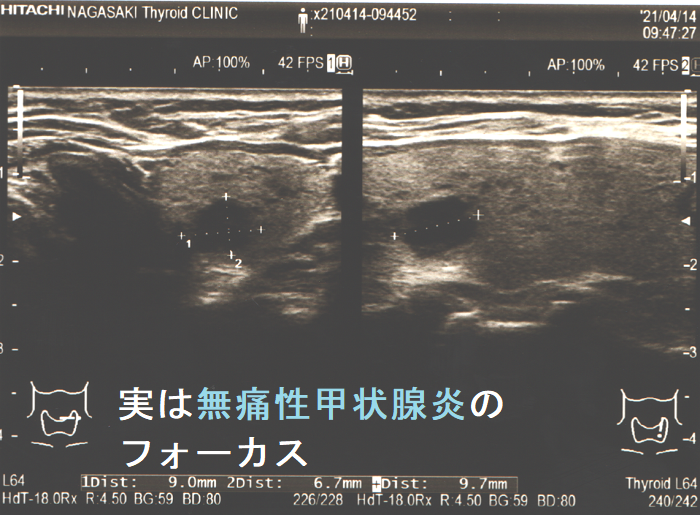 実は無痛性甲状腺炎の炎症巣 実は無痛性甲状腺炎の炎症巣
