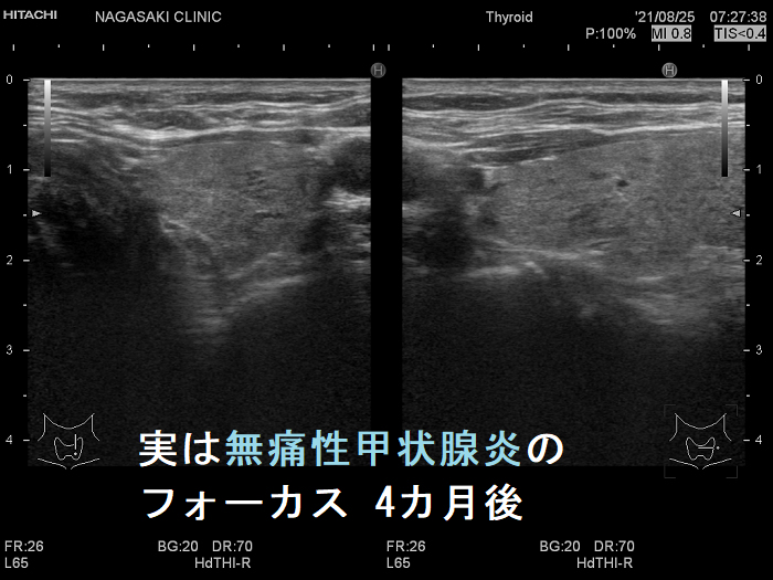 実は無痛性甲状腺炎の炎症巣 4カ月後 実は無痛性甲状腺炎の炎症巣 4カ月後