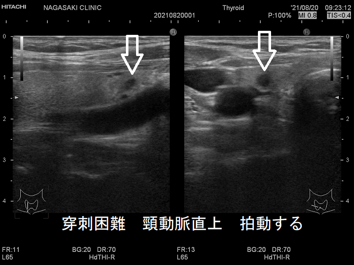頚動脈近傍で、頸動脈に連鎖して拍動する小さな甲状腺腫瘍 頚動脈近傍で、頸動脈に連鎖して拍動する小さな甲状腺腫瘍