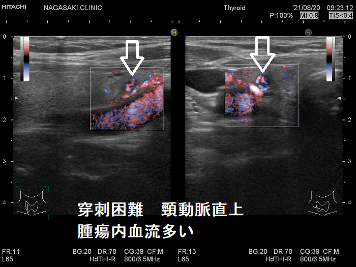 頚動脈近傍で、頸動脈に連鎖して拍動する小さな甲状腺腫瘍 内部血流多い 頚動脈近傍で、頸動脈に連鎖して拍動する小さな甲状腺腫瘍 内部血流多い