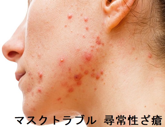 マスクトラブル 尋常性ざ瘡 マスクトラブル 尋常性ざ瘡