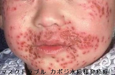 マスクトラブル カポジ水痘様発疹症 マスクトラブル カポジ水痘様発疹症