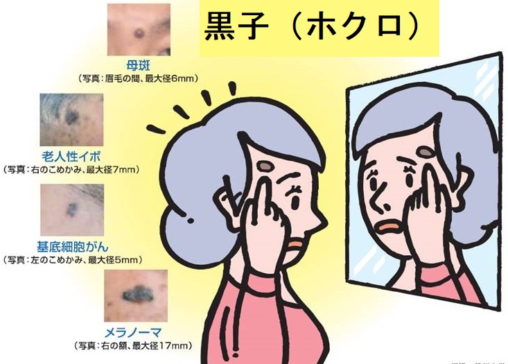 黒子(ホクロ) 黒子(ホクロ)