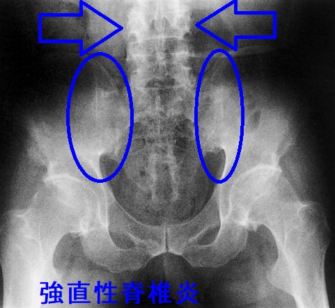 強直性脊椎炎 強直性脊椎炎
