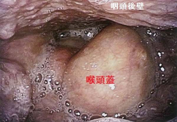 急性喉頭蓋炎 急性喉頭蓋炎