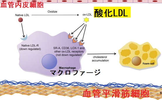 酸化LDL 酸化LDL