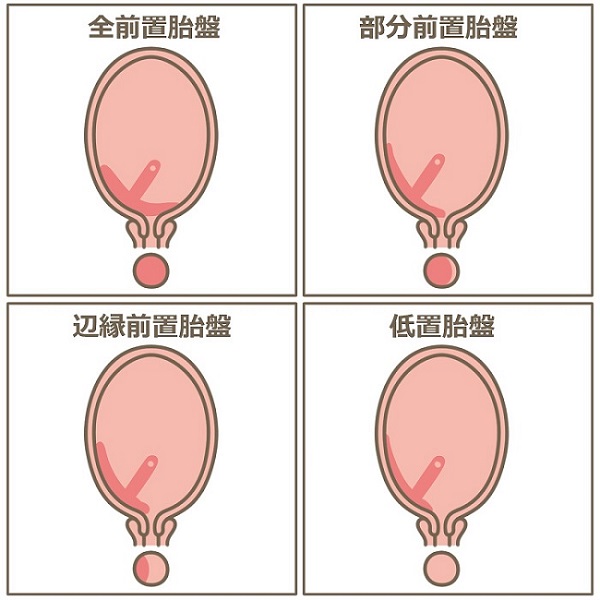 妊娠と橋本病/甲状腺機能低下症[バセドウ病 甲状腺エコー 甲状腺