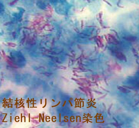 結核性リンパ節炎 Ziehl-Neelsen染色 結核性リンパ節炎 Ziehl-Neelsen染色