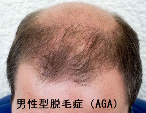 男性型脱毛症(AGA) 男性型脱毛症(AGA)