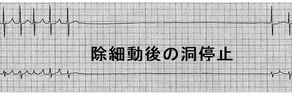 除細動後の洞停止 除細動後の洞停止