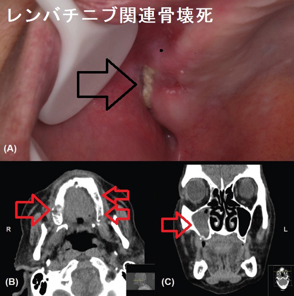 レンビマ関連骨壊死 レンビマ関連骨壊死