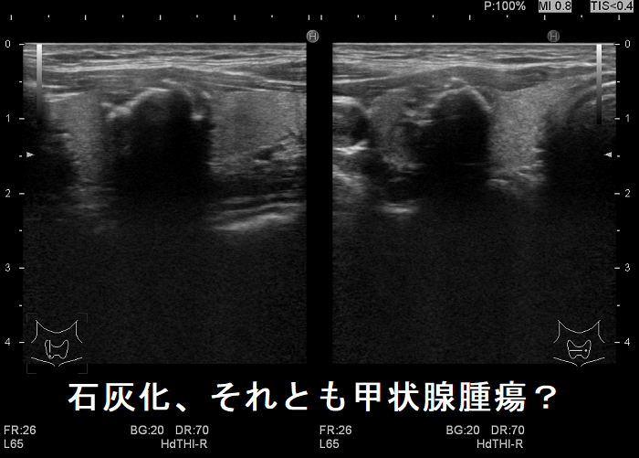 表在エコーの実学─乳腺・甲状腺・その他─ | 杉山 高 |本