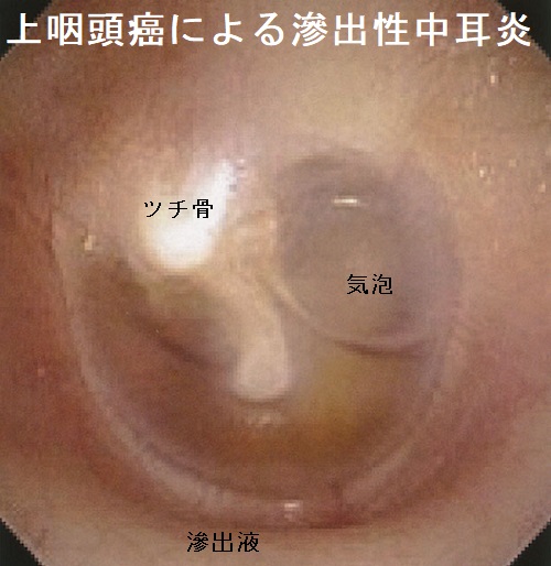 上咽頭癌による滲出性中耳炎 上咽頭癌による滲出性中耳炎