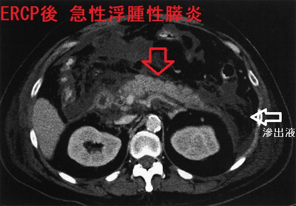 ERCP 後急性浮腫性膵炎 造影CT画像 ERCP 後急性浮腫性膵炎 造影CT画像
