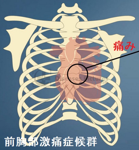 前胸部激痛症候群 前胸部激痛症候群