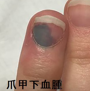 爪甲下血腫 爪甲下血腫