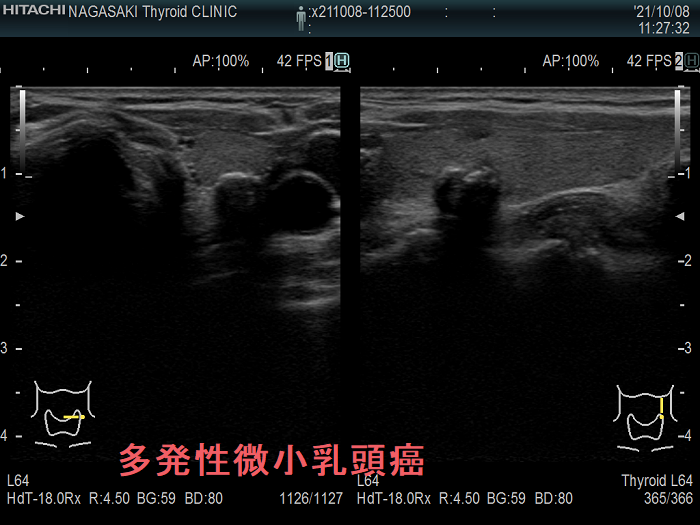 両葉多発性微小乳頭癌 超音波(エコー)画像 両葉多発性微小乳頭癌 超音波(エコー)画像