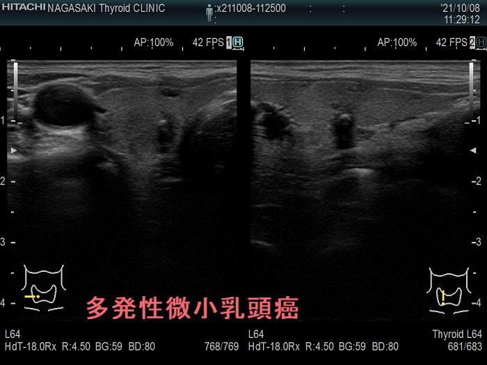 両葉多発性微小乳頭癌 超音波(エコー)画像 両葉多発性微小乳頭癌 超音波(エコー)画像