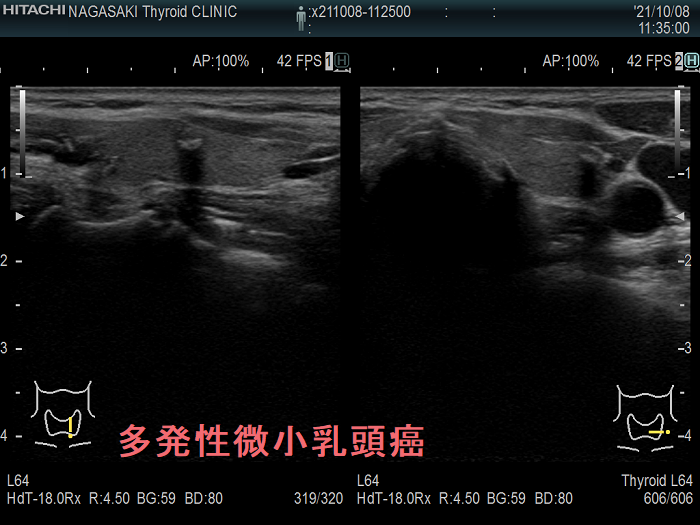 両葉多発性微小乳頭癌 3個目 超音波(エコー)画像 両葉多発性微小乳頭癌 3個目 超音波(エコー)画像