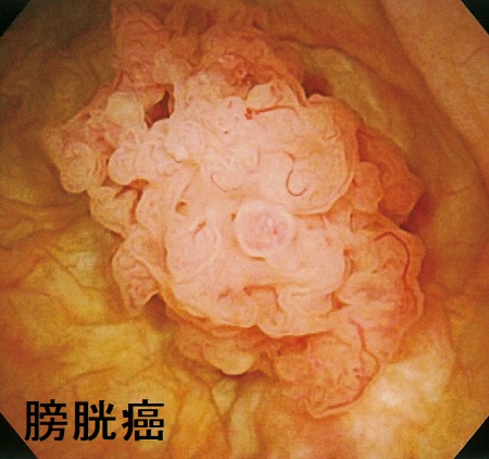 膀胱癌と甲状腺 膀胱癌と甲状腺