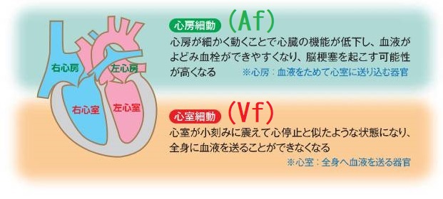 心房細動(Af)・心室細動(Vf) 心房細動(Af)・心室細動(Vf)