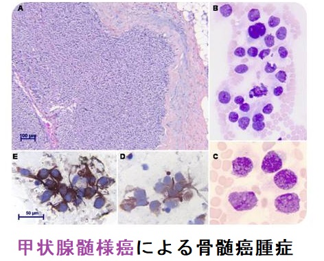 甲状腺髄様癌による骨髄癌腫症 甲状腺髄様癌による骨髄癌腫症