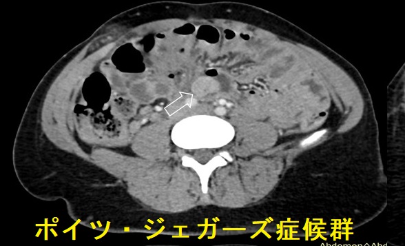ポイツ・ジェガーズ症候群 小腸ポリープ ポイツ・ジェガーズ症候群 小腸ポリープ