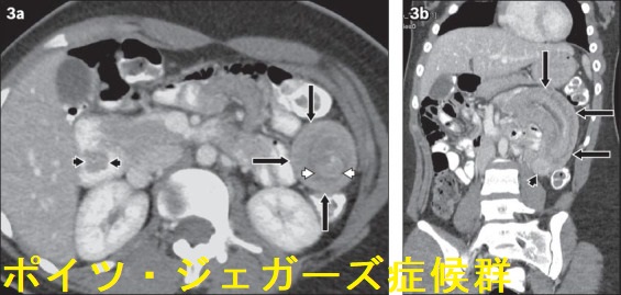 ポイツ・ジェガーズ症候群 腸重積 ポイツ・ジェガーズ症候群 腸重積