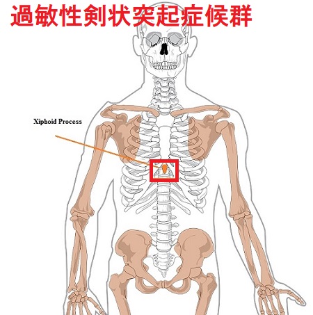 過敏性剣状突起症候群 過敏性剣状突起症候群