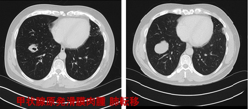 甲状腺原発滑膜肉腫 肺転移 甲状腺原発滑膜肉腫 肺転移