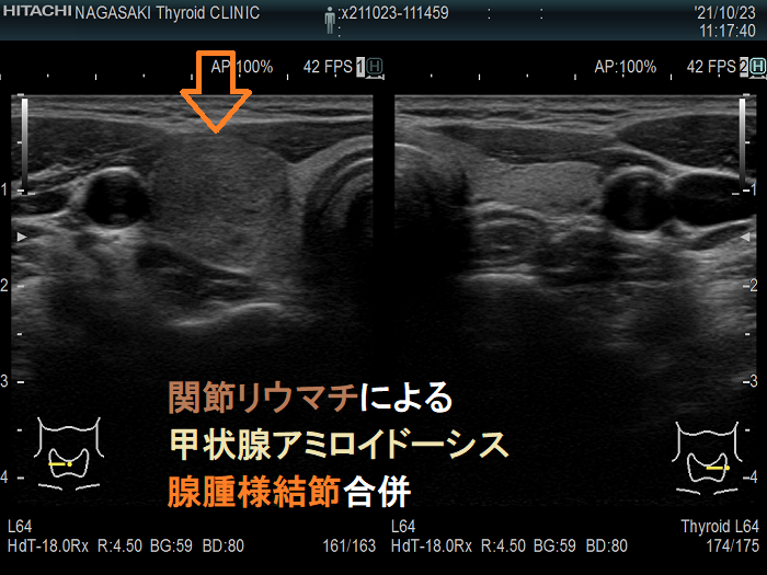 関節リウマチによる甲状腺アミロイドーシス 腺腫様結節合併 超音波(エコー)画像 関節リウマチによる甲状腺アミロイドーシス 腺腫様結節合併 超音波(エコー)画像