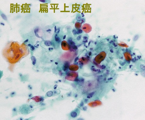 肺癌 扁平上皮癌 喀痰細胞診 肺癌 扁平上皮癌 喀痰細胞診