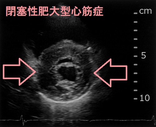 閉塞性肥大型心筋症 超音波(エコー)画像 閉塞性肥大型心筋症 超音波(エコー)画像