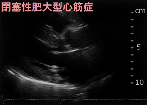 閉塞性肥大型心筋症 超音波(エコー)画像 閉塞性肥大型心筋症 超音波(エコー)画像