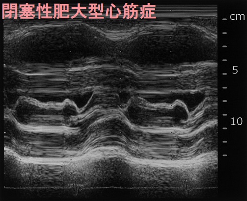 閉塞性肥大型心筋症 超音波(エコー)画像 閉塞性肥大型心筋症 超音波(エコー)画像