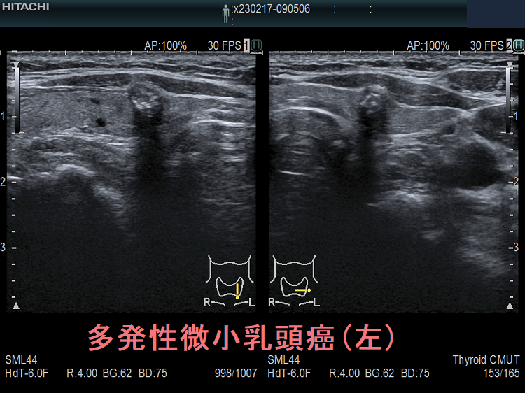 甲状腺・頸部の超音波診断 | 小西 淳二 |本 | 通販 | Amazon