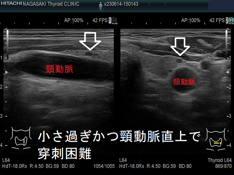 小さ過ぎかつ頸動脈直上で穿刺困難の甲状腺腫瘍 小さ過ぎかつ頸動脈直上で穿刺困難の甲状腺腫瘍