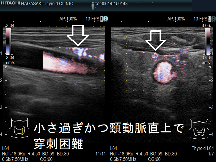 小さ過ぎかつ頸動脈直上で穿刺困難の甲状腺腫瘍 ドプラーモード 小さ過ぎかつ頸動脈直上で穿刺困難の甲状腺腫瘍 ドプラーモード