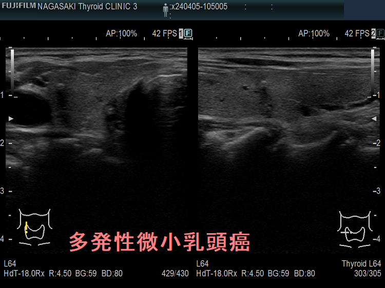 両葉多発性微小乳頭癌 4個目 超音波(エコー)画像 両葉多発性微小乳頭癌 4個目 超音波(エコー)画像
